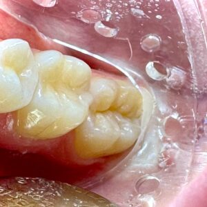 How Dental Sealants Help Protect Your Child’s Smile