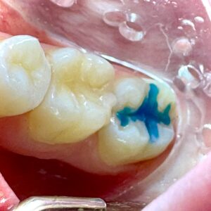 How Dental Sealants Help Protect Your Child’s Smile