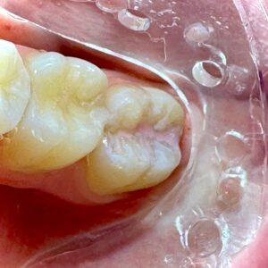 How Dental Sealants Help Protect Your Child’s Smile